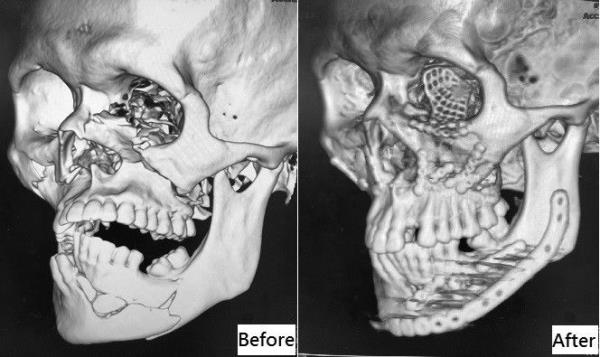 顏部骨頭大量位移、碎裂，不止鼻樑歪斜、兩眼不對稱，更無法張嘴進食，屬於複雜性顏面骨折。