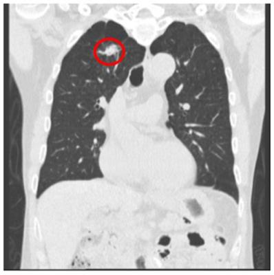 肺部低劑量電腦斷層影像