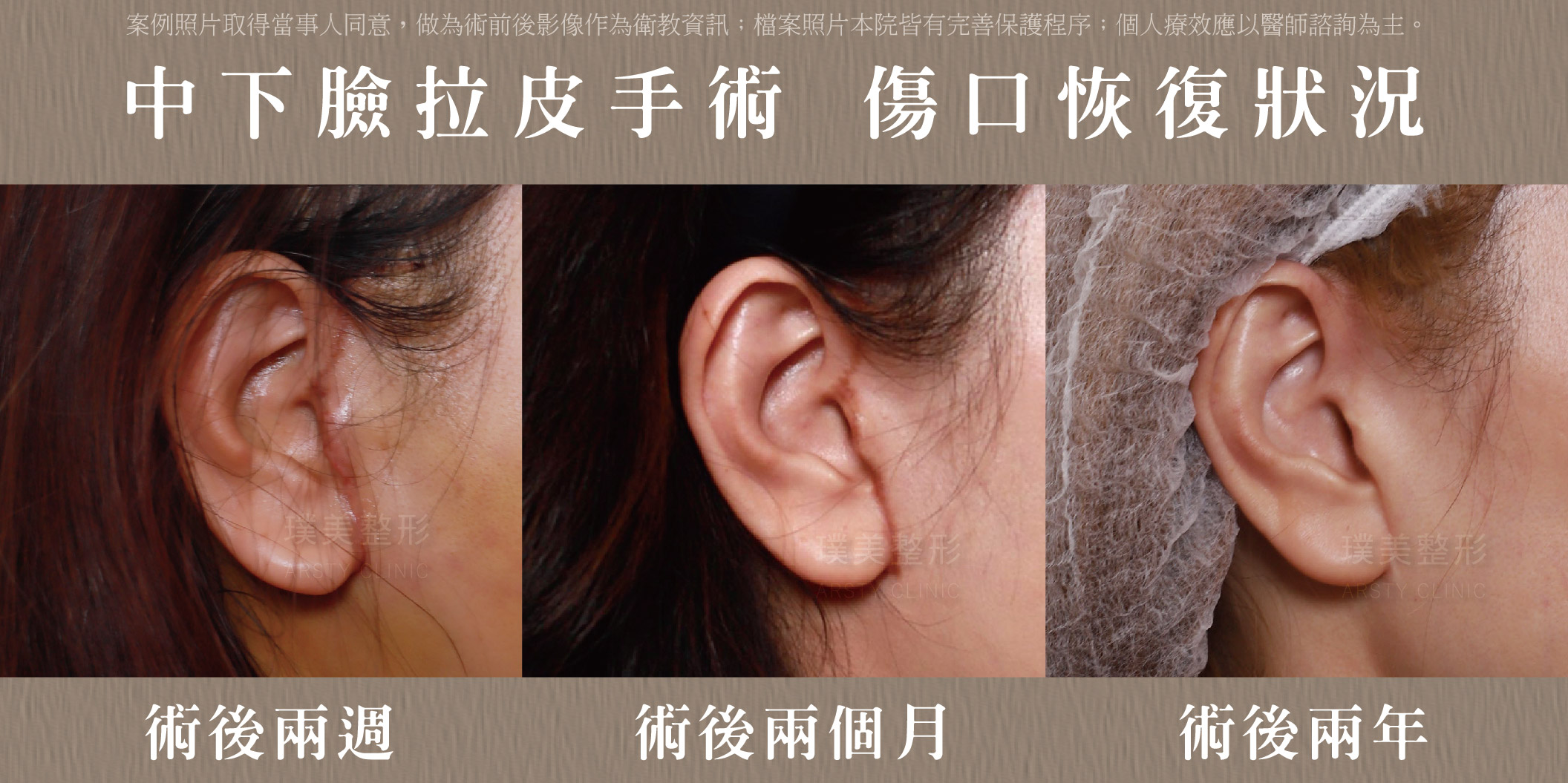 台湾拉皮医师深筋膜中下脸拉皮伤口恢复期