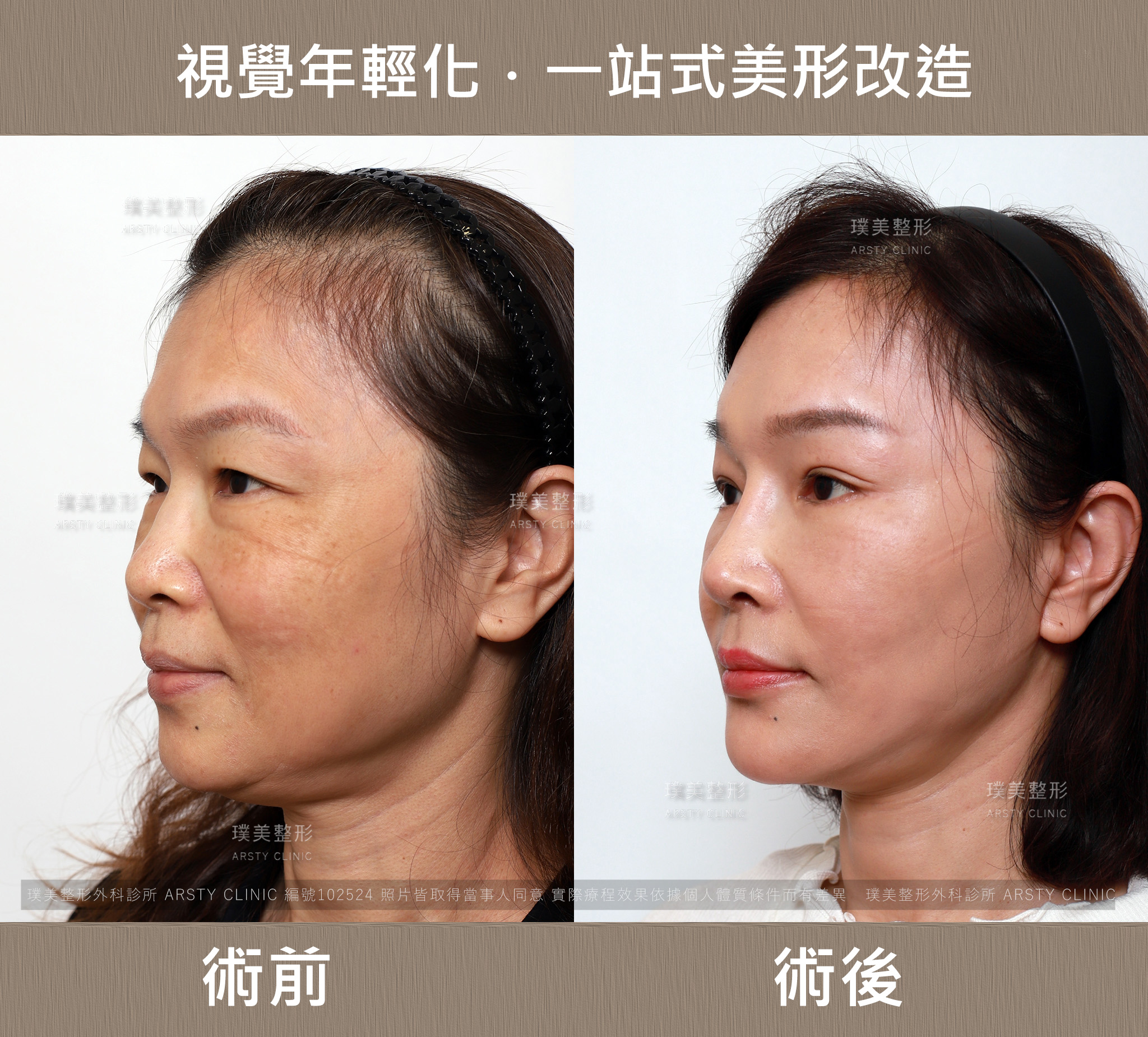 台湾拉皮医师推荐-全脸拉皮合并双眼皮、垫下巴手术案例