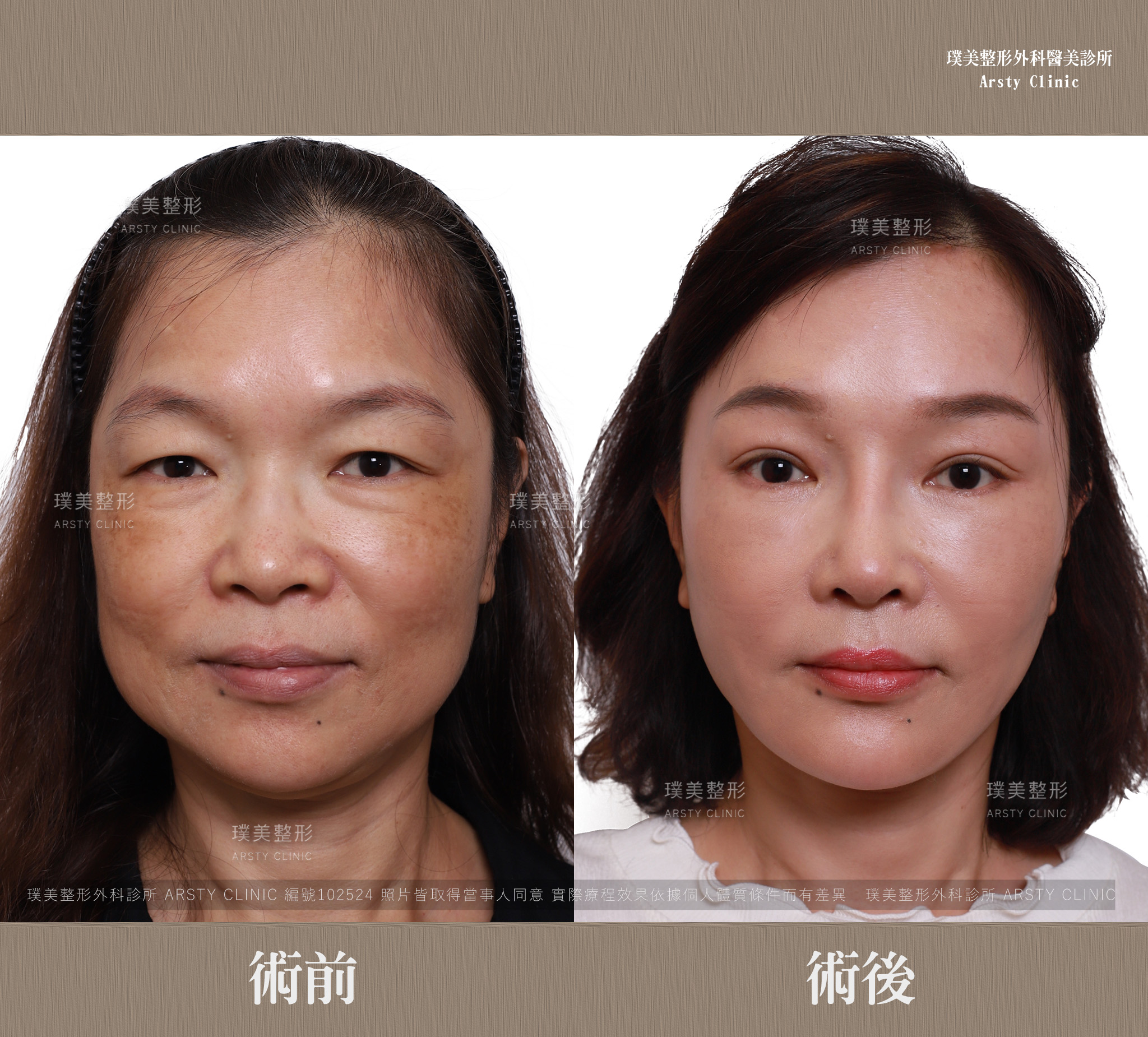 台湾拉皮医师推荐-全脸拉皮合并双眼皮手术，双眼更有神