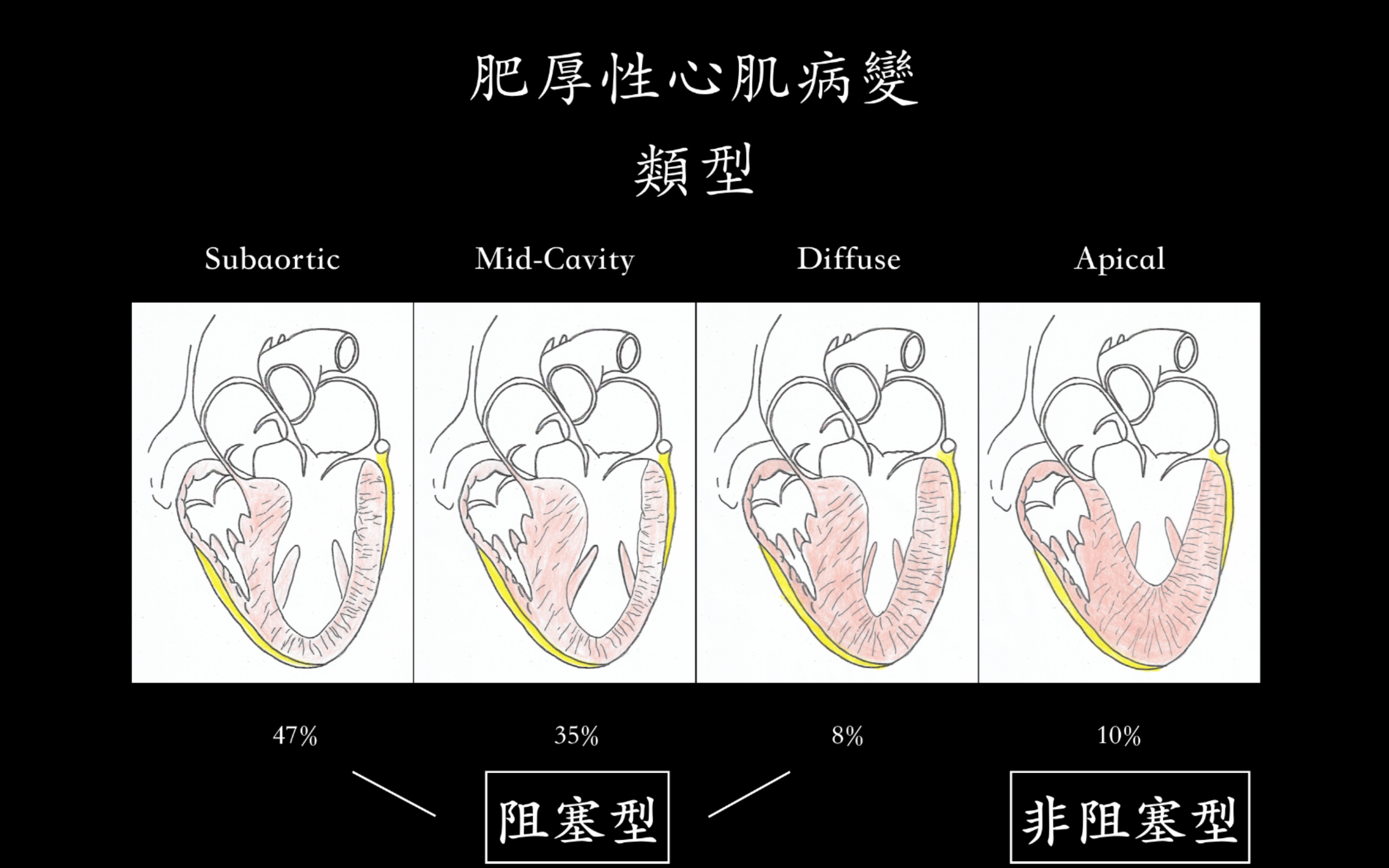 肥厚性心肌病變類型