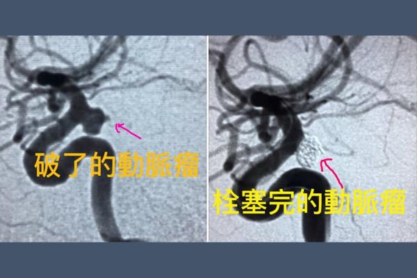 聯新國際醫院神經醫學中心以血管攝影機器執行血管瘤微創手術