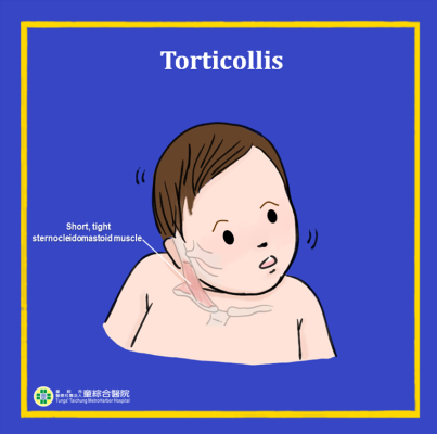 Torticollis Child