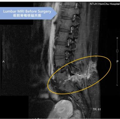 Typically, when a disc is damaged like this, it becomes unstable and requires a fusion surgery for s