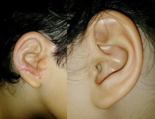 Operasi plastik untuk membentuk kembali telinga indah gadis Thailand, memberikannya kegembiraan