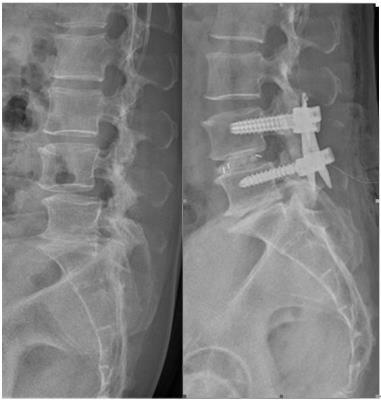 Minimal Invasive Spine Surgery