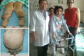 Peru's "elephant leg girl" lymphedema is reborn in Taiwan