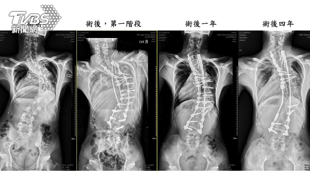 背少年」番玉磊成功手術後每年定期追蹤，均維持良好狀態。(照片中醫大附醫提供)